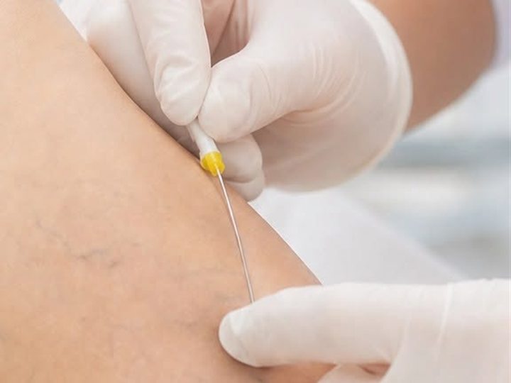 Profesional de la salud aplicando un tratamiento en la pierna de un paciente con v&aacute;rices